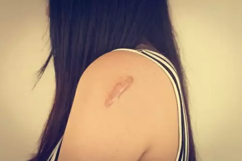 ¿Cómo curar una cicatriz para que no deje marca?