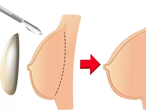 ¿Cómo saber si necesitas un levantamiento de senos, implantes mamarios o ambos?