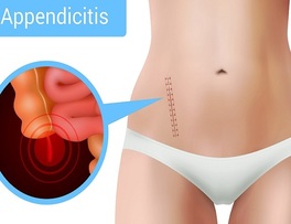 ¿Cómo se cura la apendicitis?