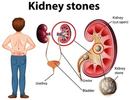 ¿Por qué salen piedras en los riñones?